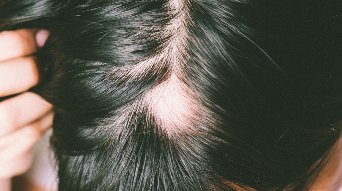 Alopecia Treatment in Mumbai at Mumbai Cosmetic Centre