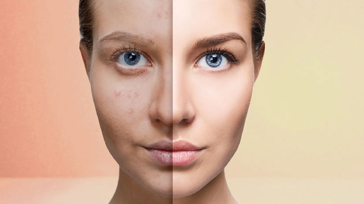 Botox Treatment in Mumbai at Mumbai Cosmetic Centre