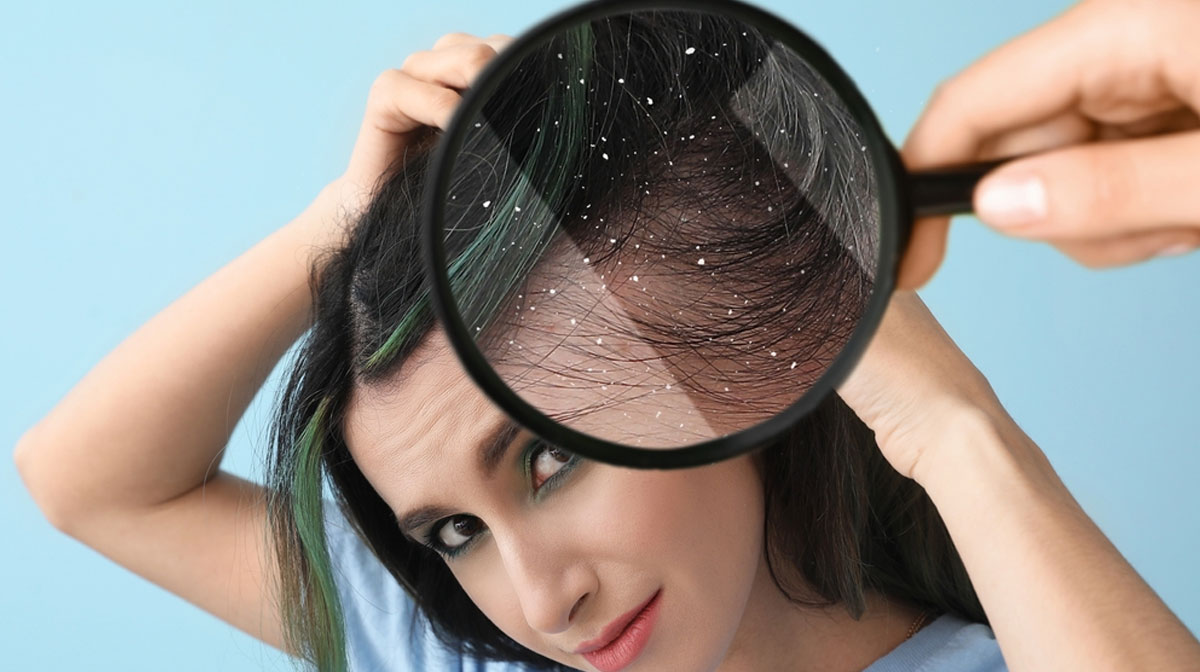 Dandruff Treatment in Mumbai at Mumbai Cosmetic Centre