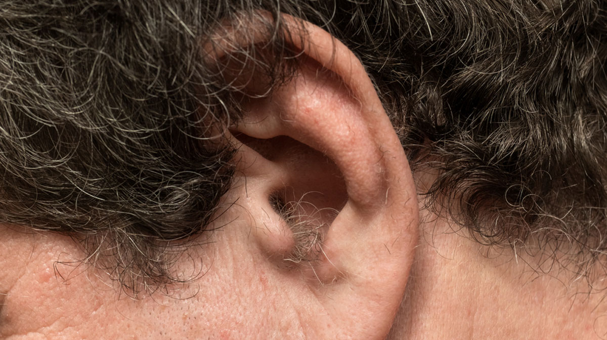 Ear lobe hair removal Treatment in Mumbai at Mumbai cosmetic centre