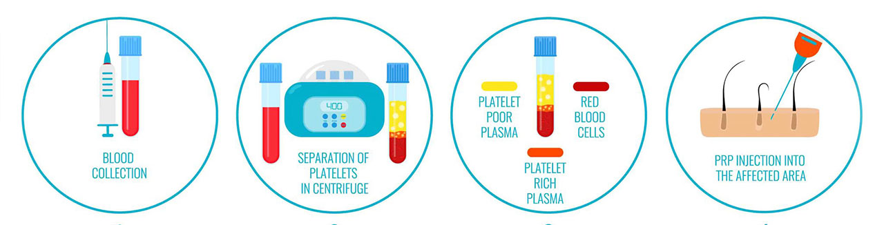 Step by Step PRP Treatment Process in Mumbai