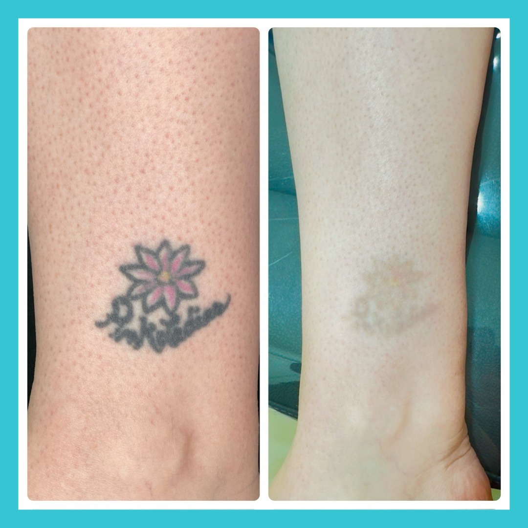 Laser Tattoo Removal in mumbai at mumbai cosmetic centre, Before After Result of Hand tattoo removal