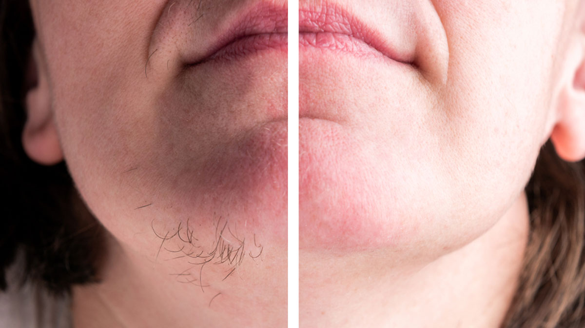 Hypertrichosis Treatment in Mumbai at Mumbai Cosmetic Centre