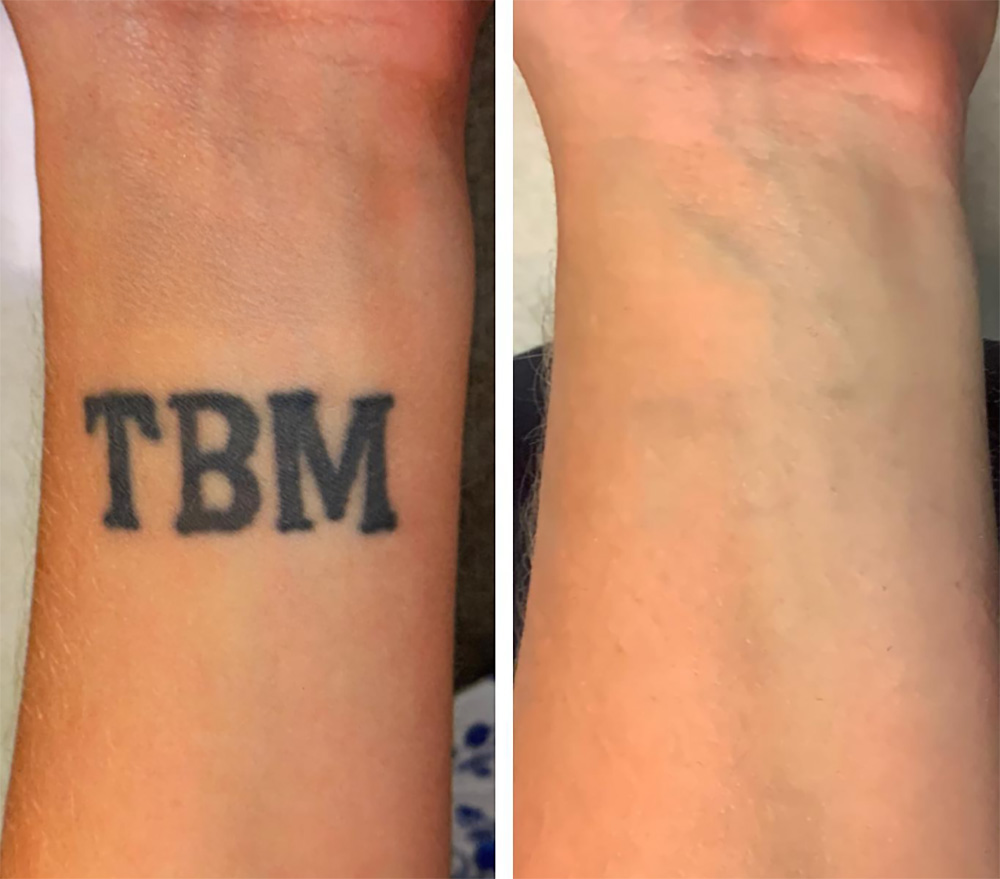 Laser Tattoo Removal in mumbai at mumbai cosmetic centre, Before-After Result after 3 weeks