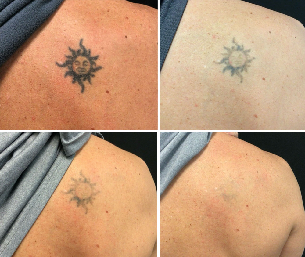 Laser Tattoo Removal in mumbai at mumbai cosmetic centre, Before-After Result after 4 weeks